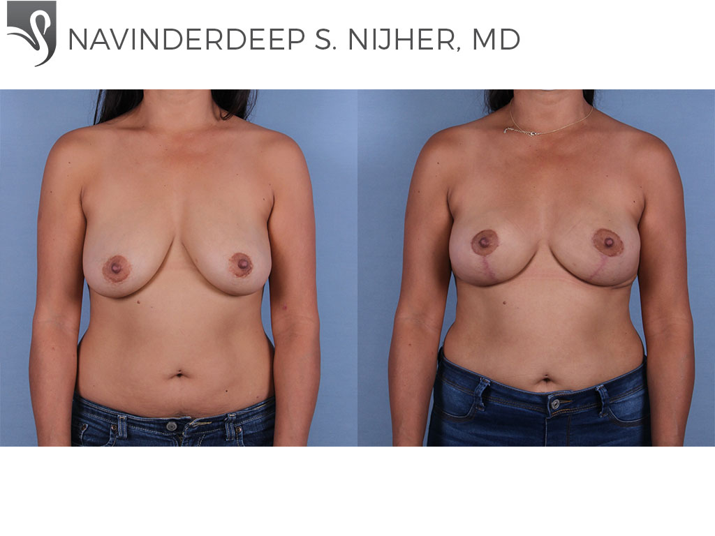 Before and After Image: Breast Lift (Mastopexy) Case #68326 - front