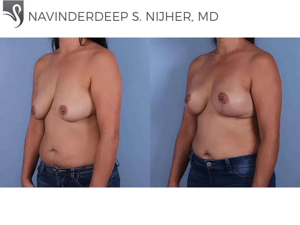 Before and After Image: Breast Lift (Mastopexy) Case #68326 - left-front-oblique