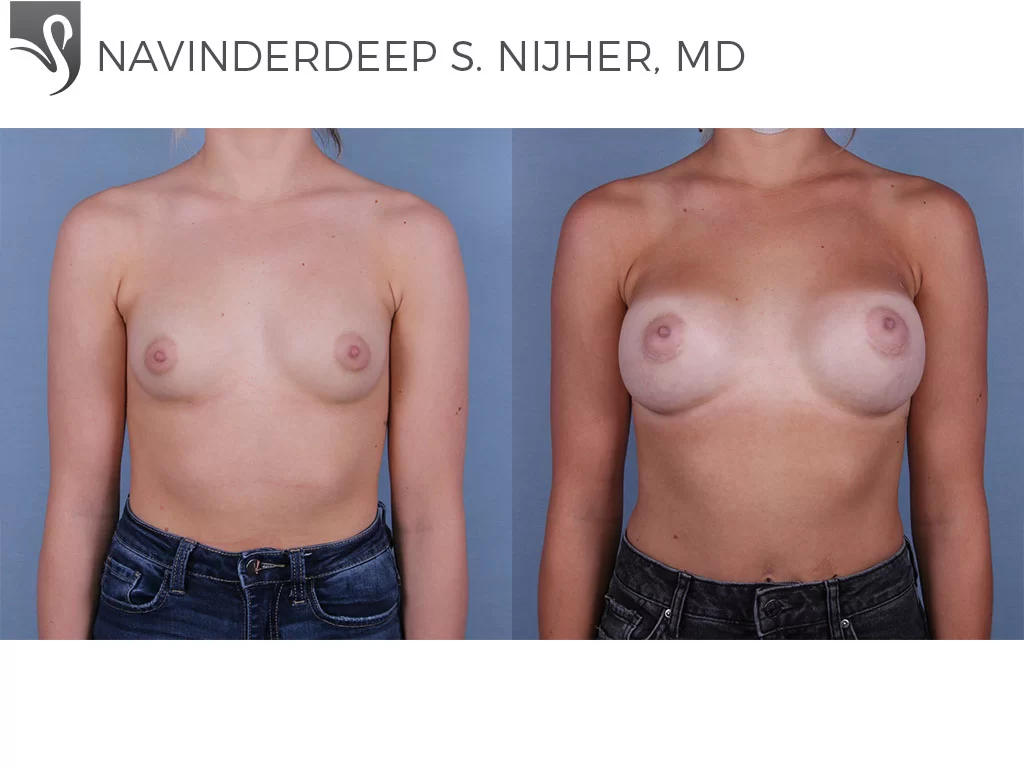 Before and After Image: Breast Augmentation Case #68421 - front