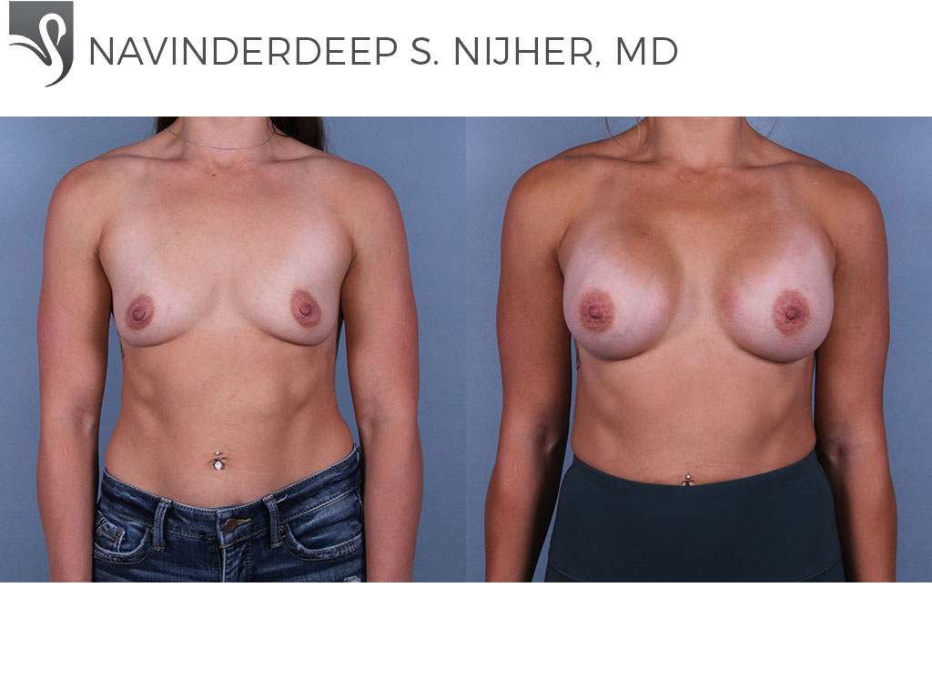 Before and After Image: Breast Augmentation Case #68435 - front