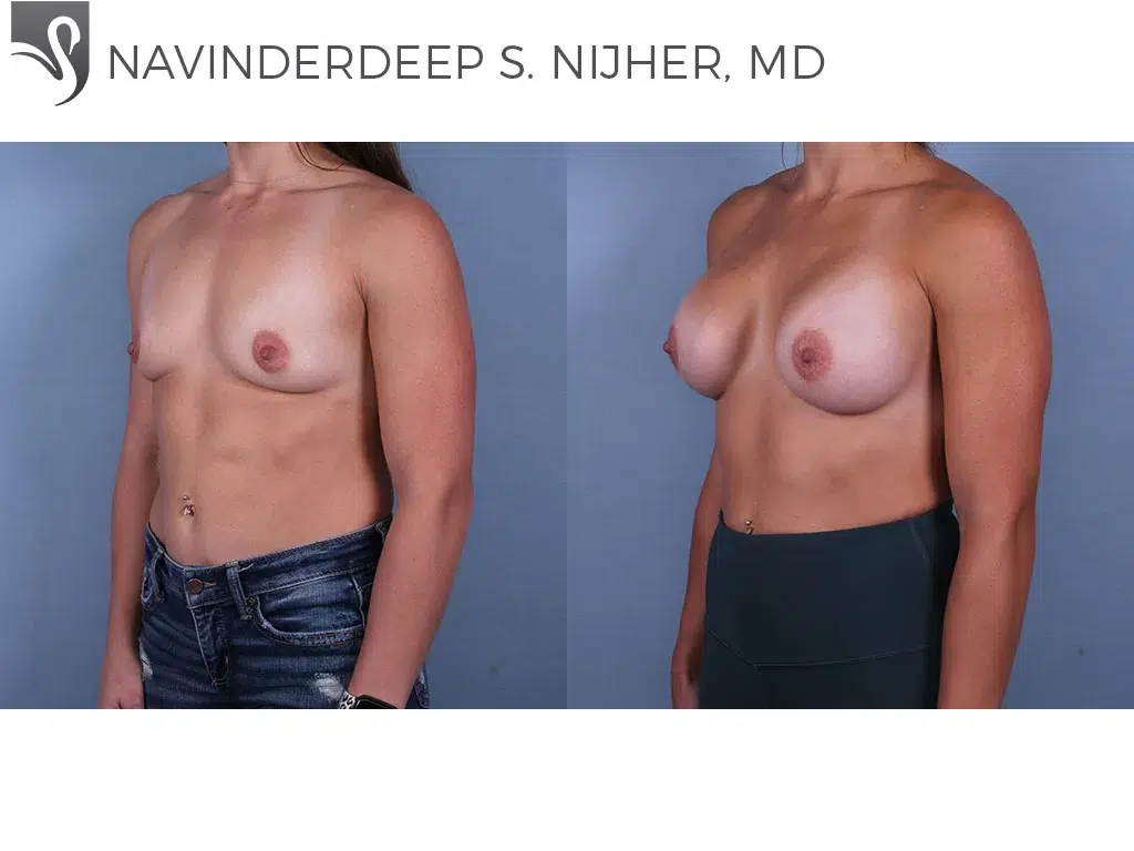 Before and After Image: Breast Augmentation Case #68435 - left-front-oblique