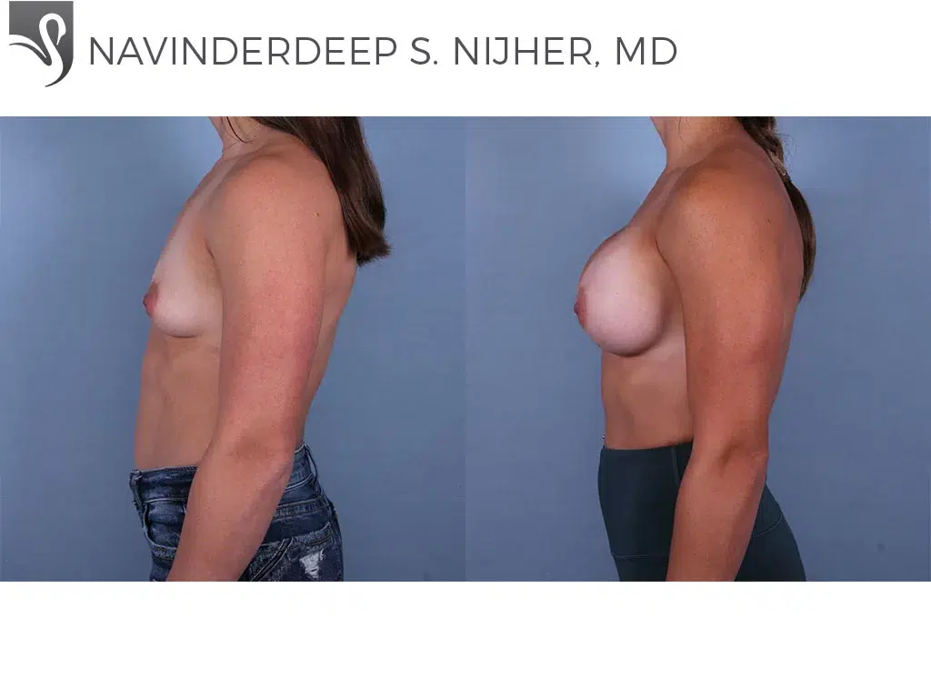 Before and After Image: Breast Augmentation Case #68435 - left-side