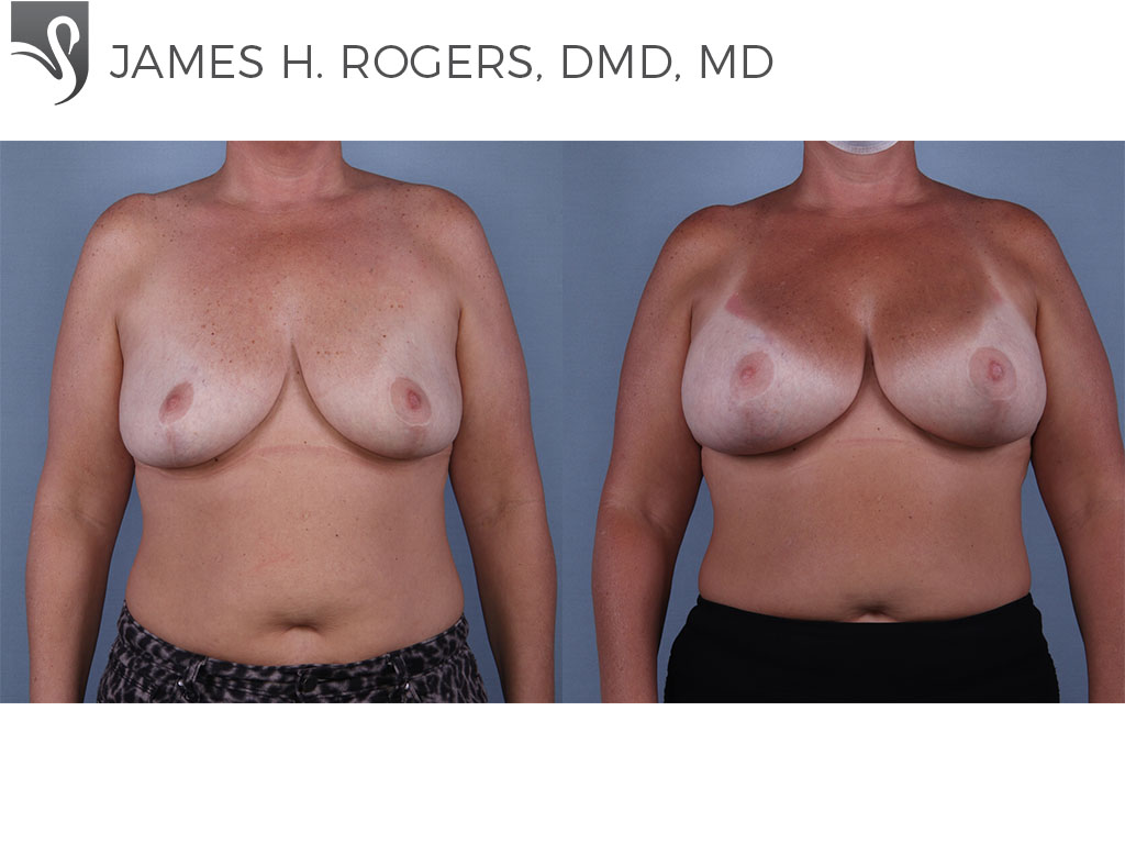 Before and After Image: Breast Augmentation Case #68529 -