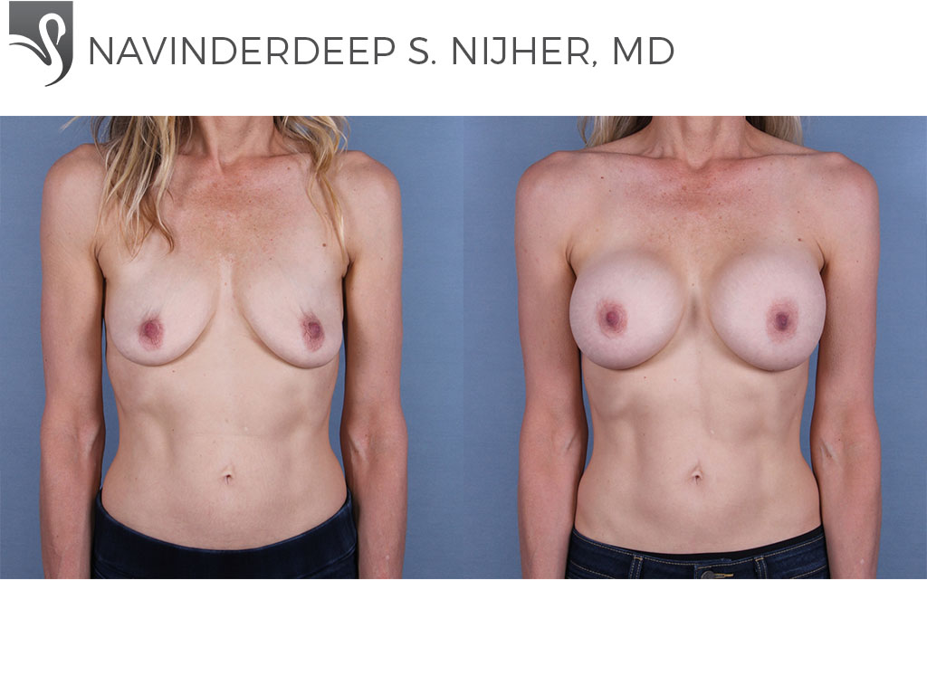 Before and After Image: Breast Augmentation Case #68541 - front