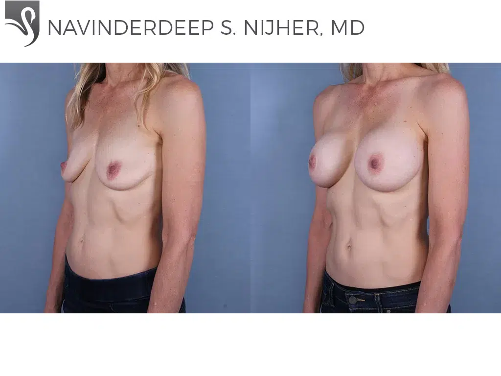 Before and After Image: Breast Augmentation Case #68541 - left-front-oblique