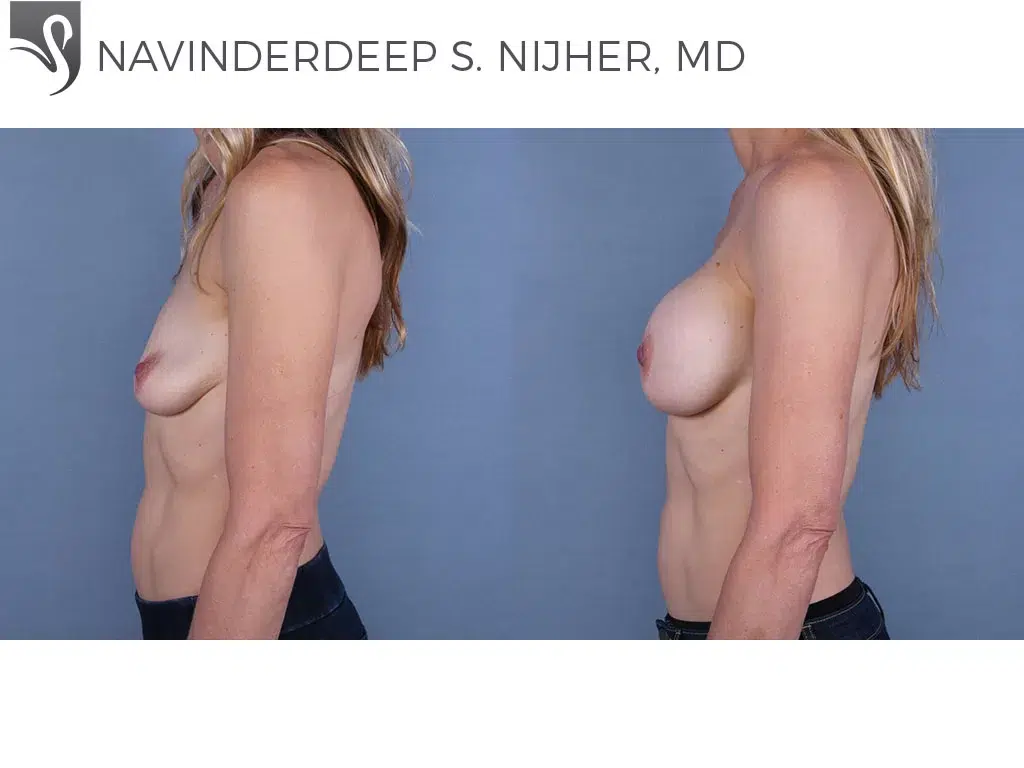 Before and After Image: Breast Augmentation Case #68541 - left-side