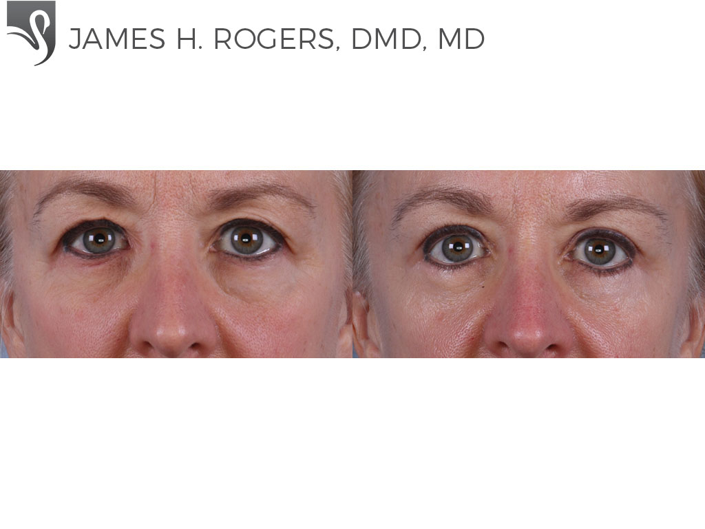 Before and After Image: Eyelid Surgery Case #68907