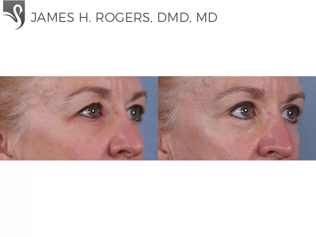 Before and After Image: Eyelid Surgery Case #68907 - right-front-oblique