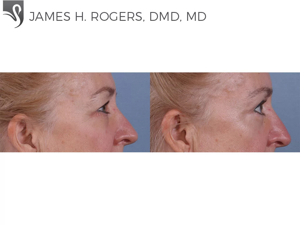 Before and After Image: Eyelid Surgery Case #68907 - right-side