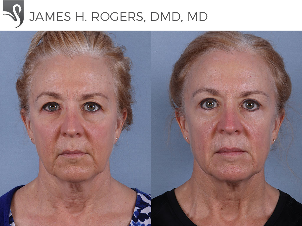 Before and After Image: Face Lift Case #68907