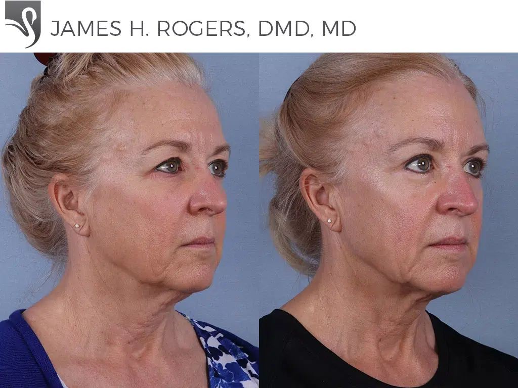 Before and After Image: Face Lift Case #68907 - right-front-oblique