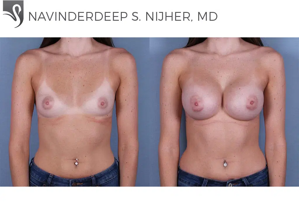 Before and After Image: Breast Augmentation Case #69194 - front