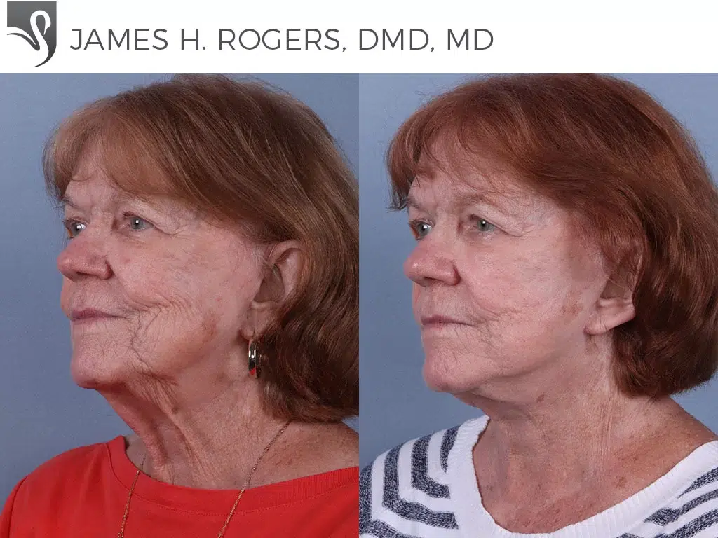 Before and After Image: Face Lift Case #69251 - left-front-oblique