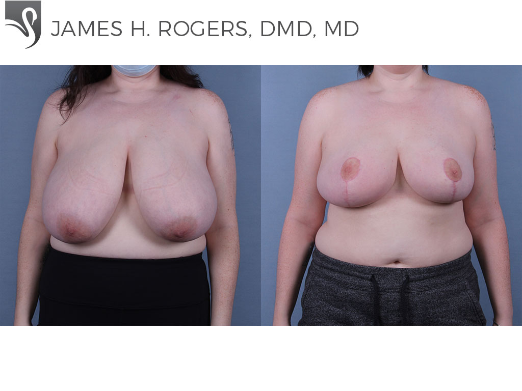 Before and After Image: Female Breast Reduction Case #69328 - front
