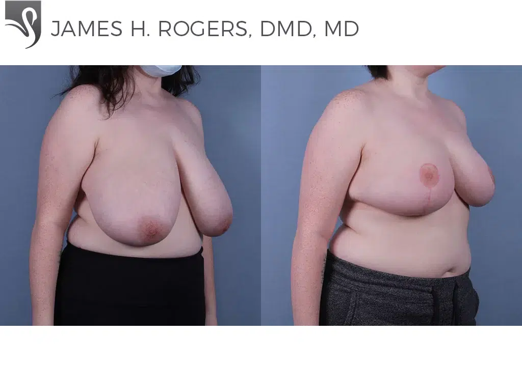 Before and After Image: Female Breast Reduction Case #69328 - right-front-oblique