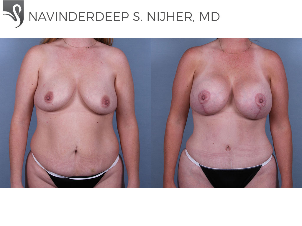 Before and After Image: Breast Lift (Mastopexy) Case #69898 - front