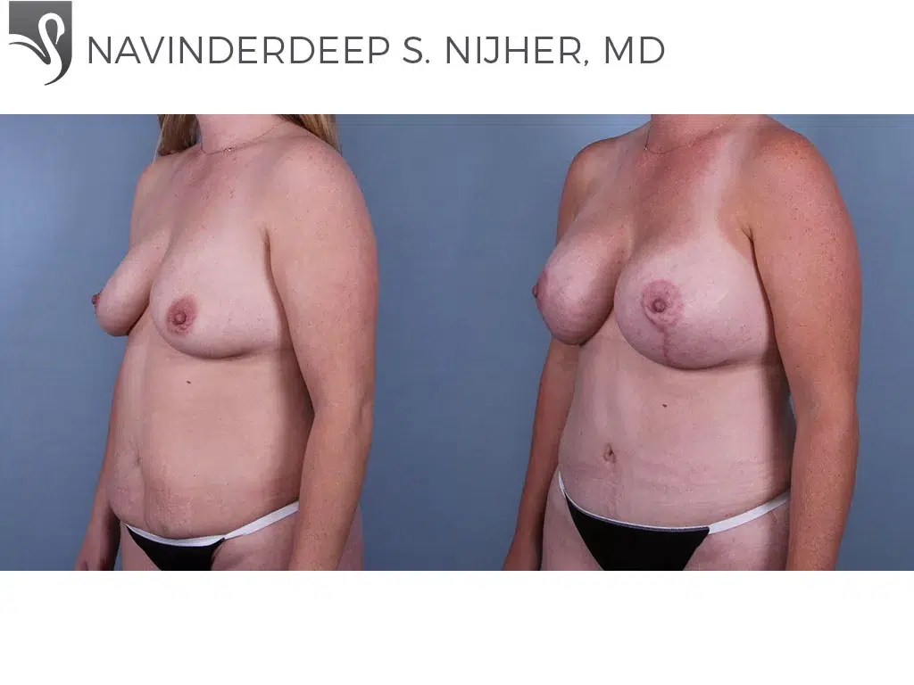 Before and After Image: Breast Lift (Mastopexy) Case #69898 - left-front-oblique