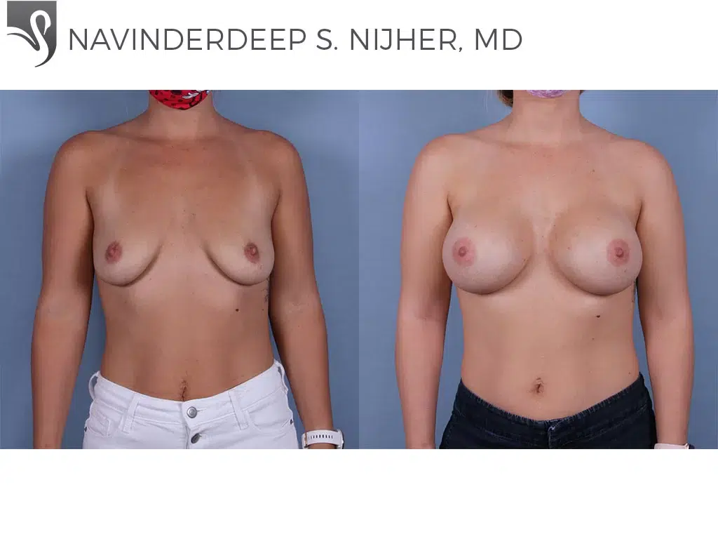 Before and After Image: Breast Augmentation Case #70011 - front