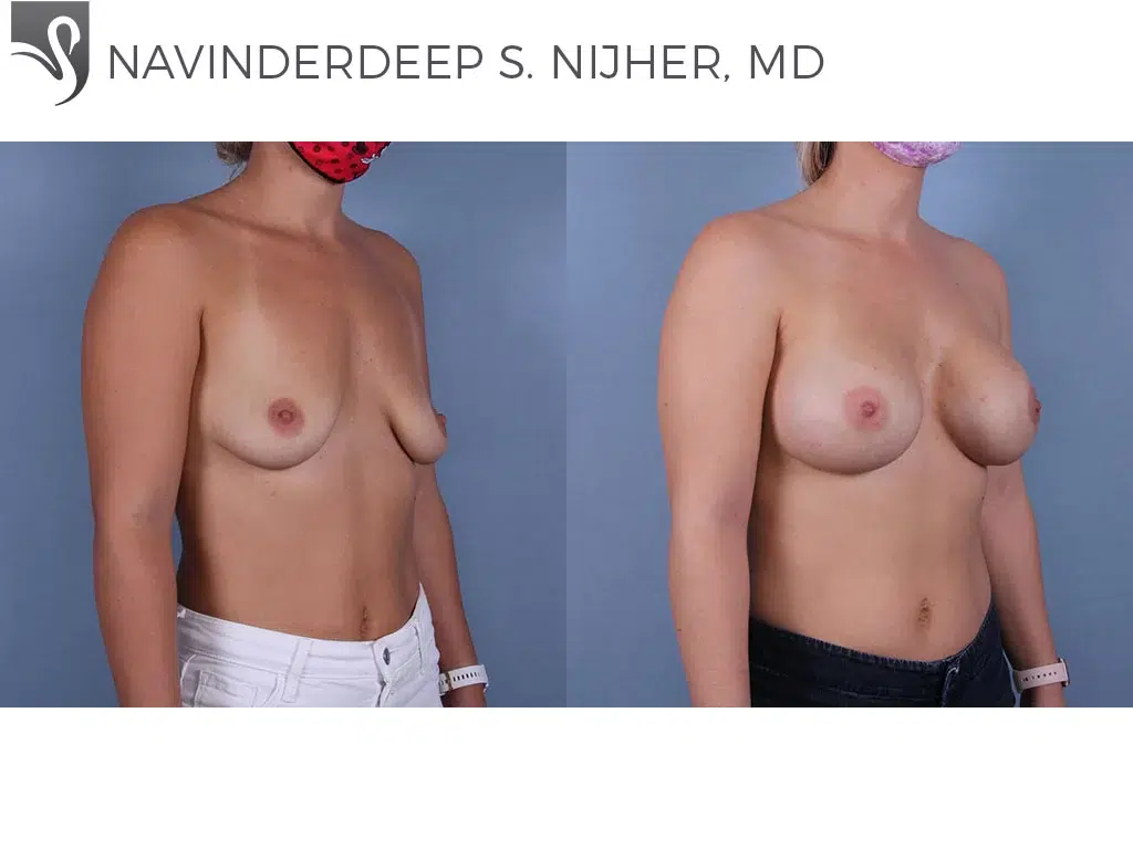 Before and After Image: Breast Augmentation Case #70011 - right-front-oblique
