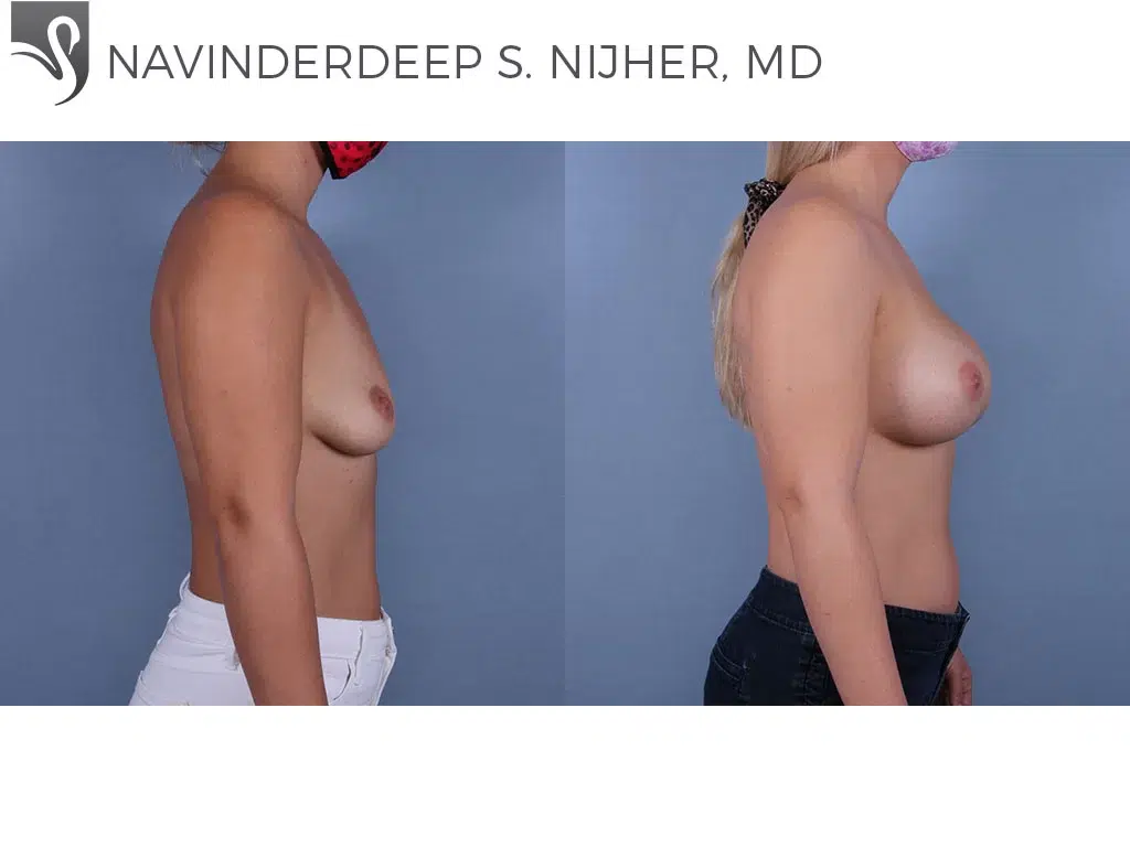 Before and After Image: Breast Augmentation Case #70011 - right-side