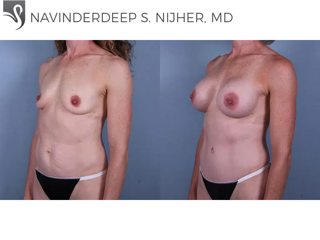 Before and After Image: Breast Augmentation Case #70328 - left-front-oblique