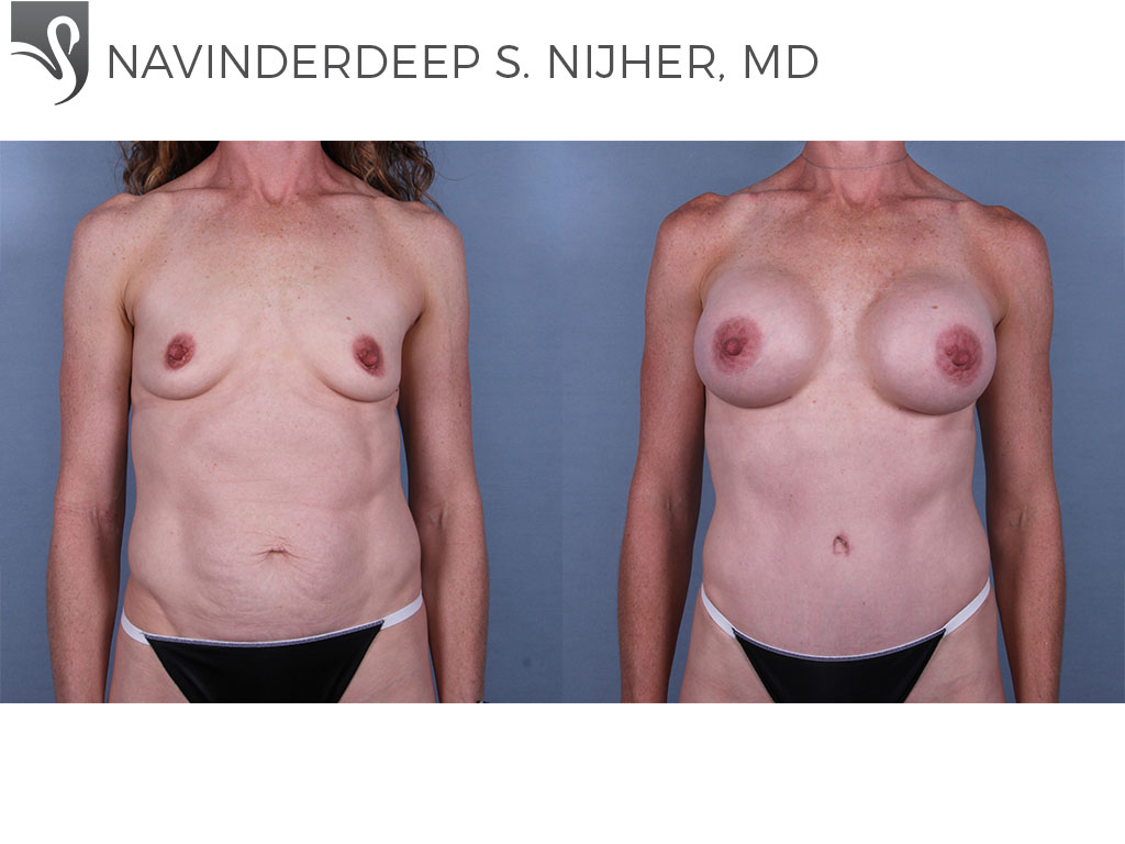 Before and After Image: Breast Augmentation Case #70328 - front