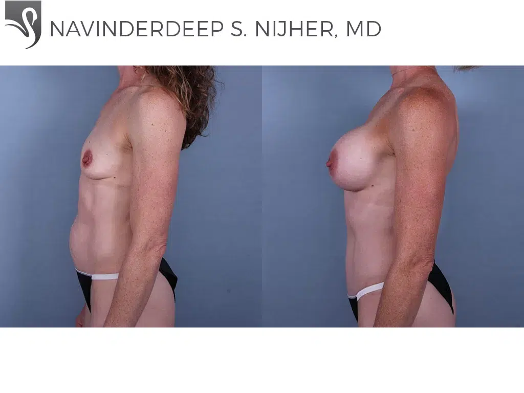 Before and After Image: Breast Augmentation Case #70328 - left-side