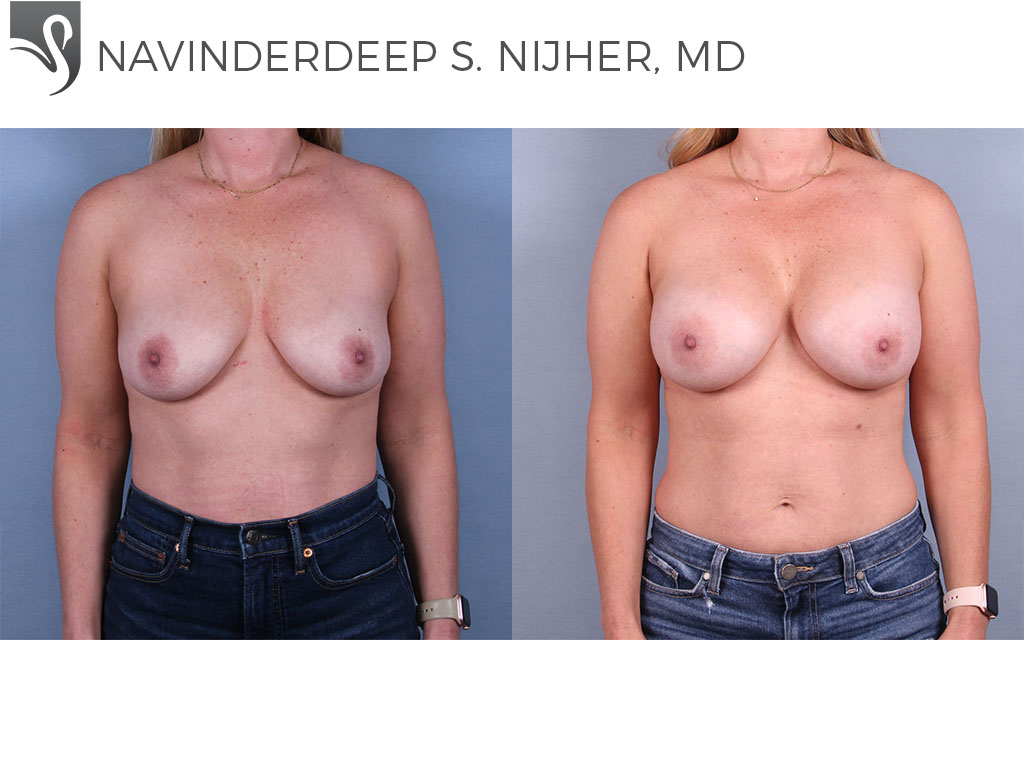 Before and After Image: Breast Augmentation Case #70484 - front