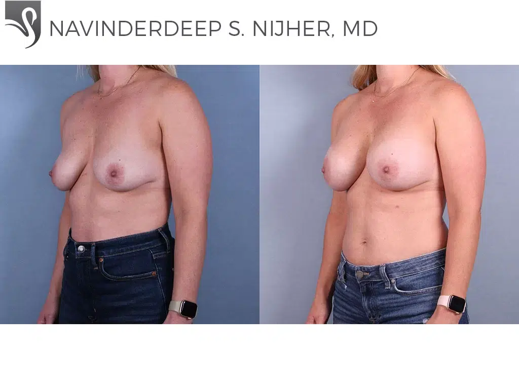 Before and After Image: Breast Augmentation Case #70484 - left-front-oblique