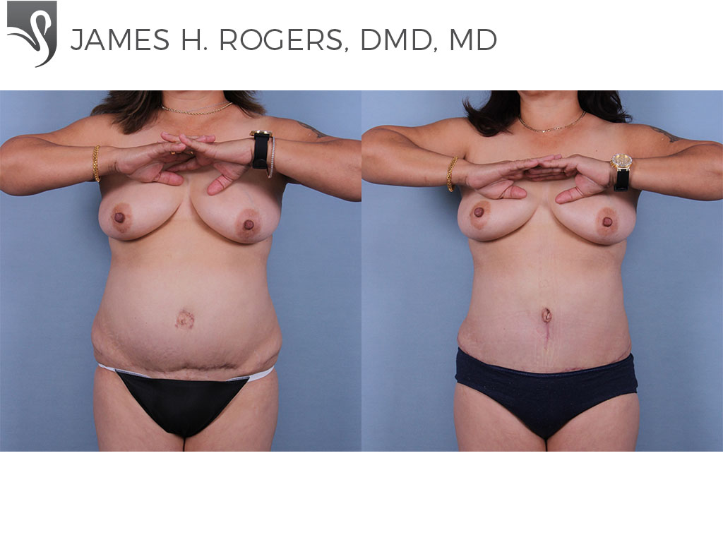 Before and After Image: Abdominoplasty (Tummy Tuck) Case #70880 - front