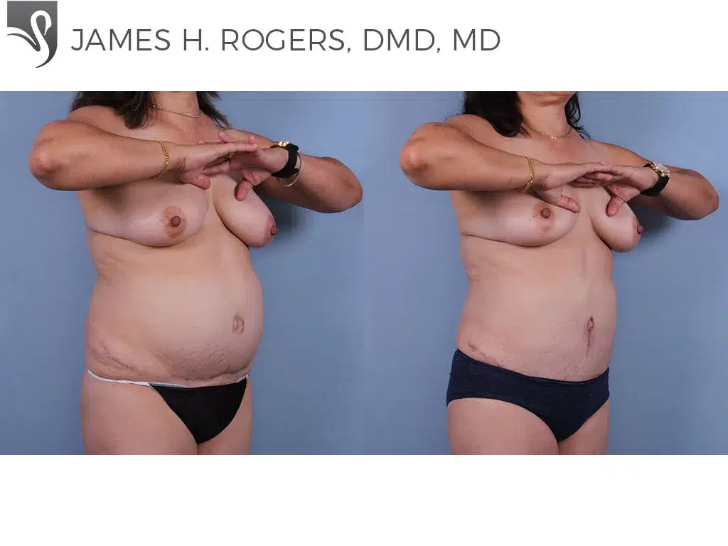 Before and After Image: Abdominoplasty (Tummy Tuck) Case #70880 - right-front-oblique