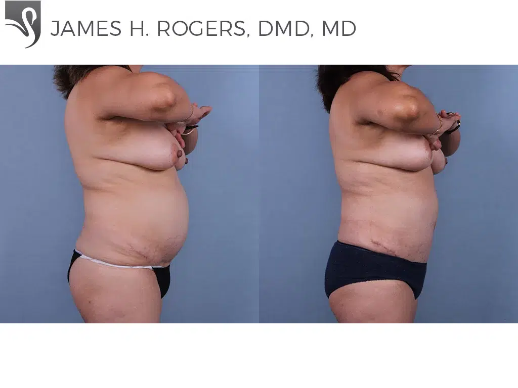 Before and After Image: Abdominoplasty (Tummy Tuck) Case #70880 - right-side