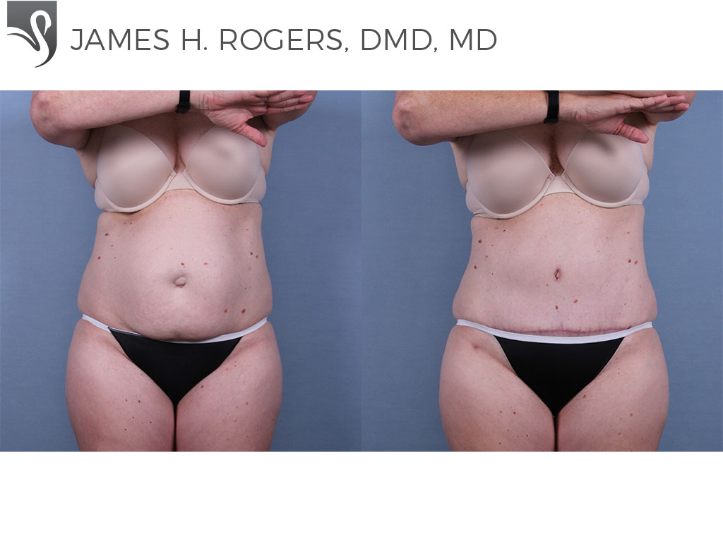 Before and After Image: Abdominoplasty (Tummy Tuck) Case #71038