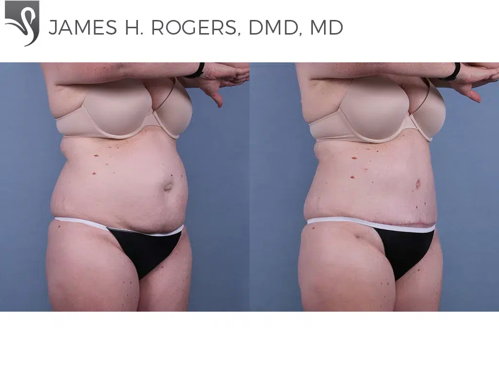 Before and After Image: Abdominoplasty (Tummy Tuck) Case #71038 - right-front-oblique