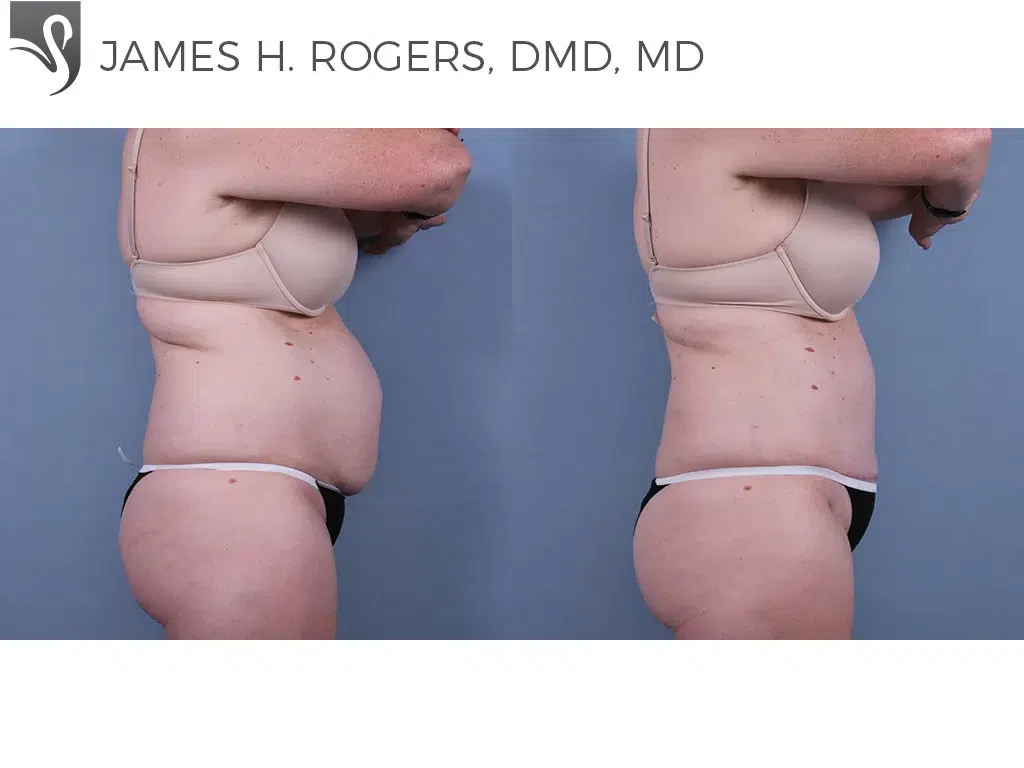 Before and After Image: Abdominoplasty (Tummy Tuck) Case #71038 - right-side