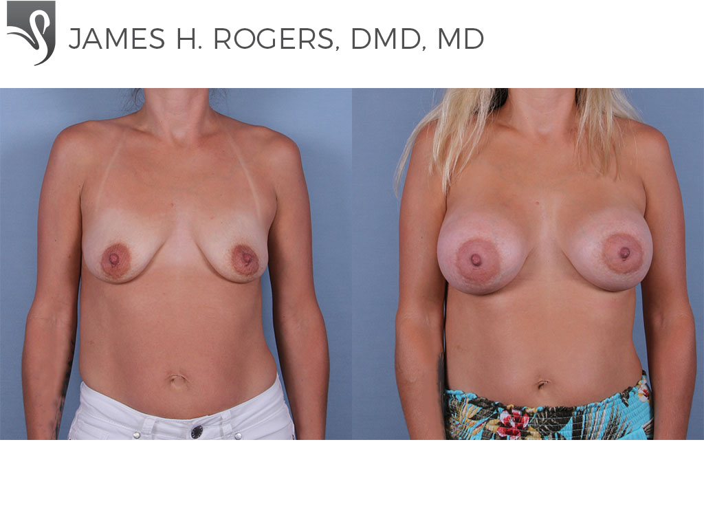 Before and After Image: Breast Augmentation Case #71069