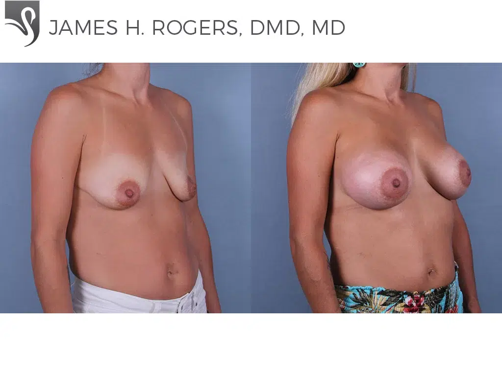 Before and After Image: Breast Augmentation Case #71069 - right-front-oblique