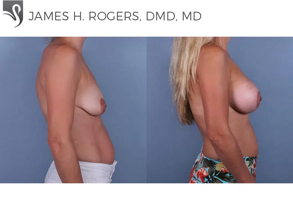 Before and After Image: Breast Augmentation Case #71069 - right-side