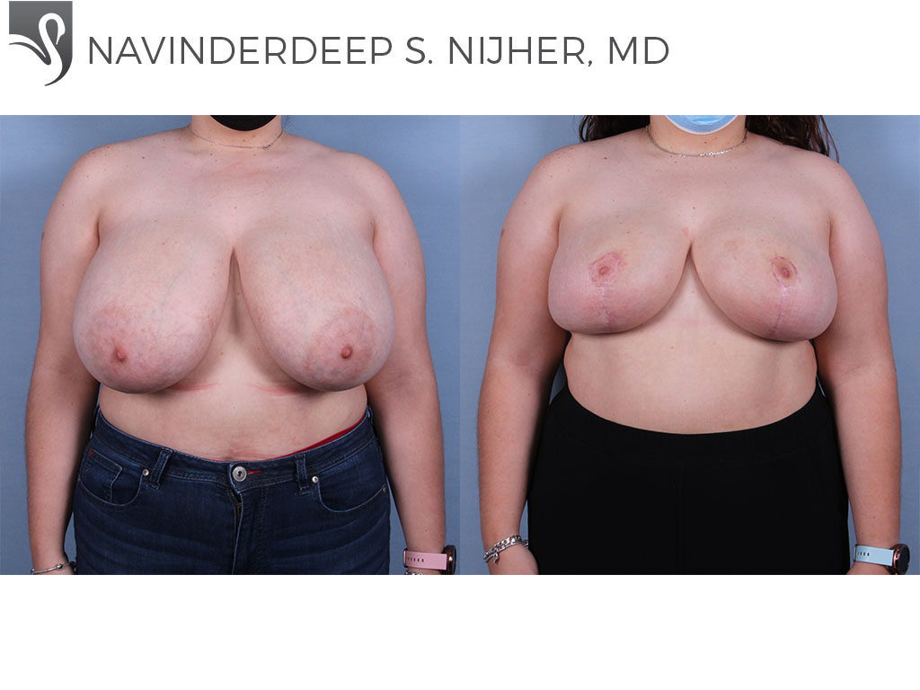 Before and After Image: Female Breast Reduction Case #71192 - front