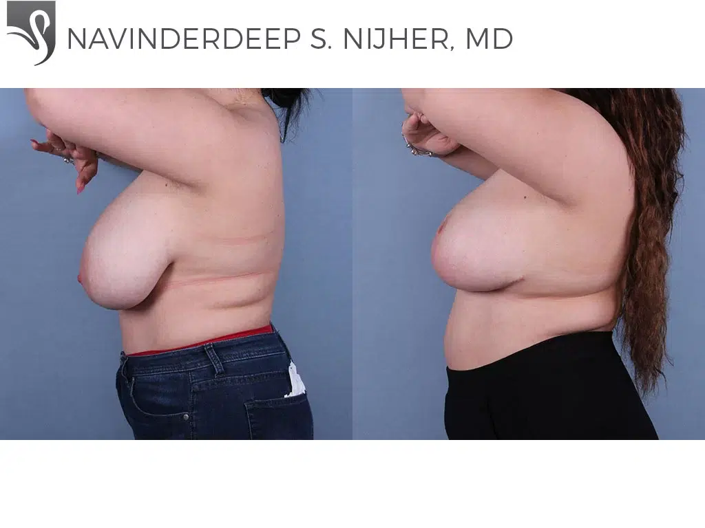 Before and After Image: Female Breast Reduction Case #71192 - left-side