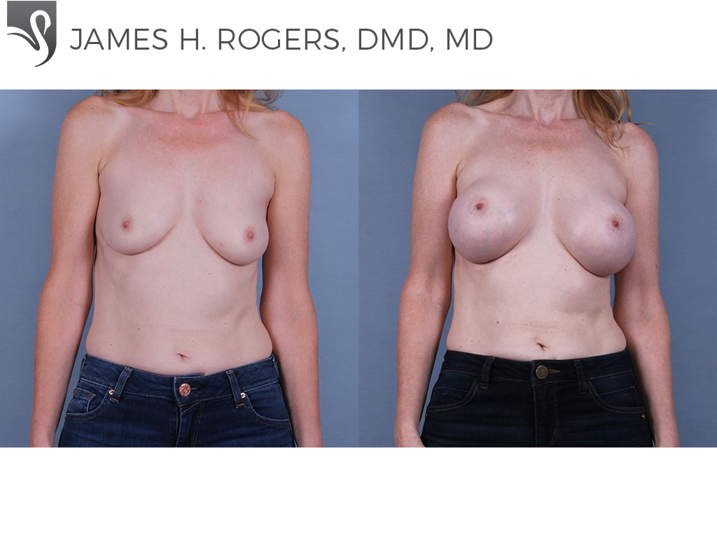 Before and After Image: Breast Augmentation Case #71200