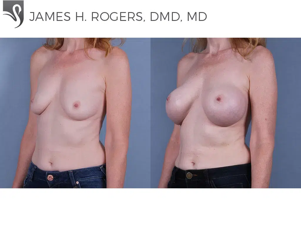 Before and After Image: Breast Augmentation Case #71200 - left-front-oblique