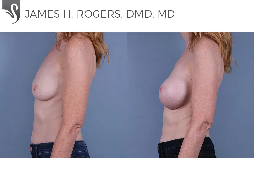 Before and After Image: Breast Augmentation Case #71200 - left-side