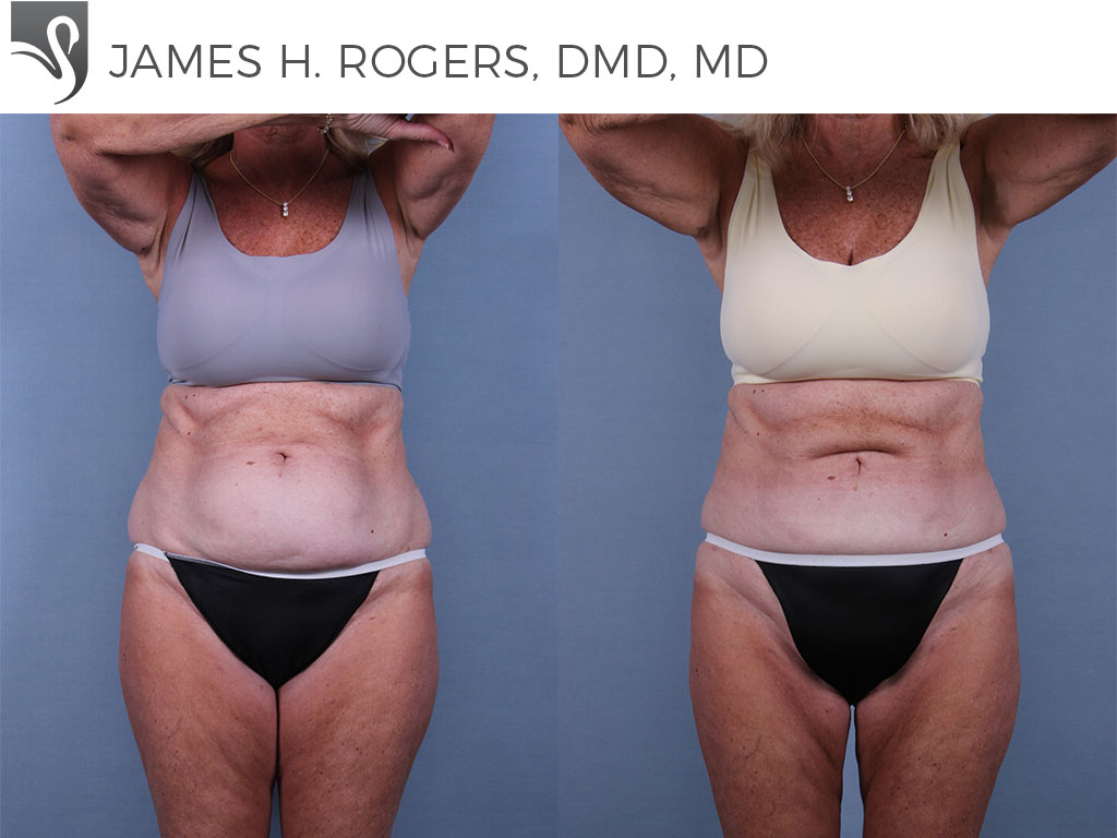Before and After Image: Liposuction Case #71283 - front