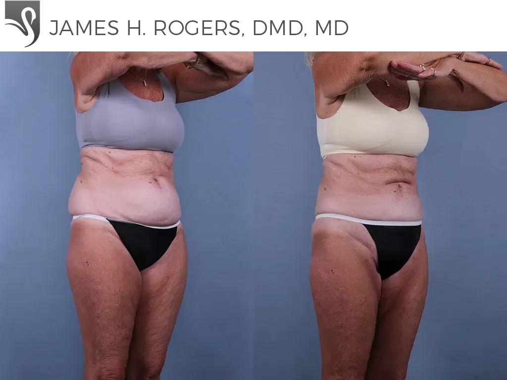 Before and After Image: Liposuction Case #71283 - right-front-oblique