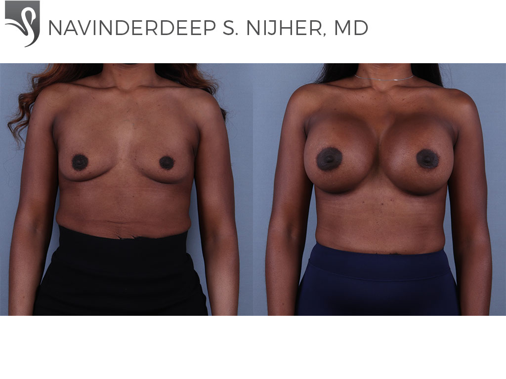 Before and After Image: Breast Augmentation Case #71308 - front