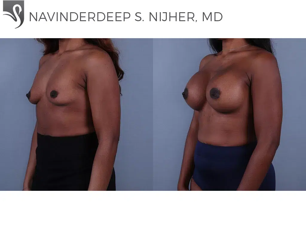 Before and After Image: Breast Augmentation Case #71308 - left-front-oblique