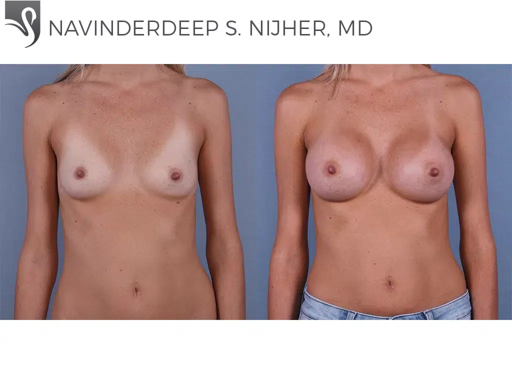 Before and After Image: Breast Augmentation Case #71314 - front