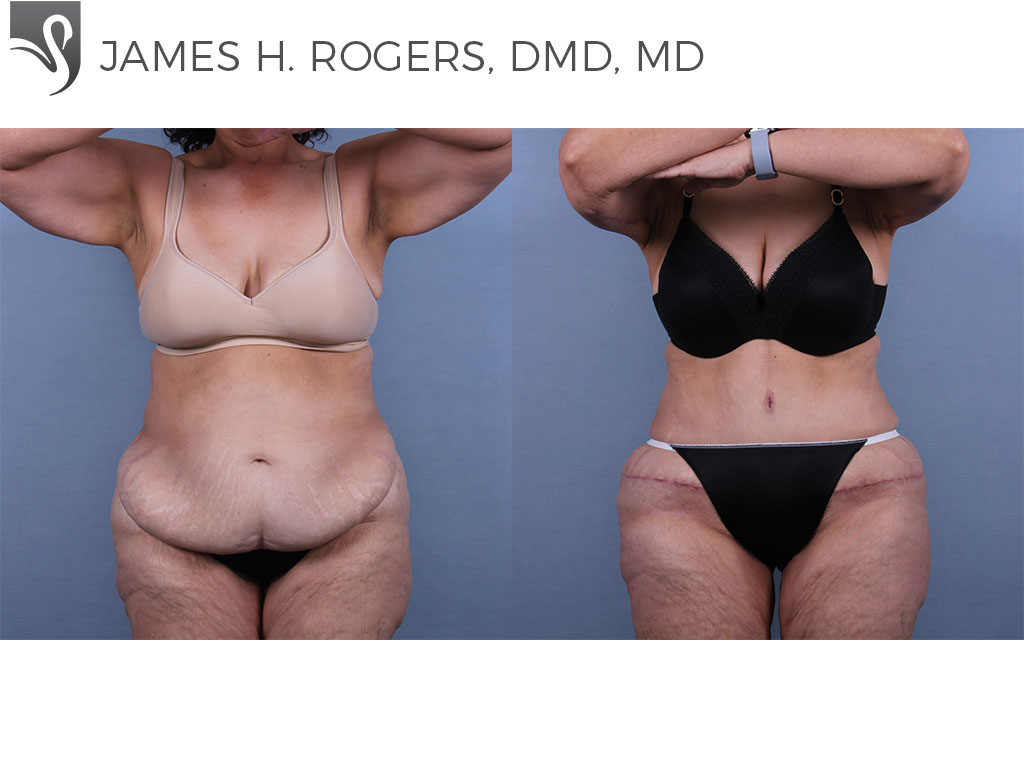 Before and After Image: Abdominoplasty (Tummy Tuck) Case #71361