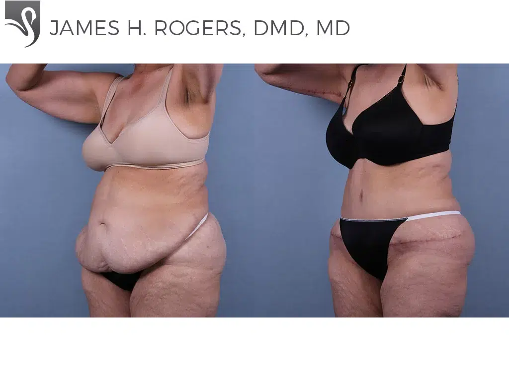 Before and After Image: Abdominoplasty (Tummy Tuck) Case #71361 - left-front-oblique